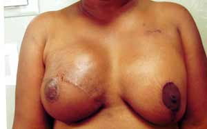 Breast Reconstruction
