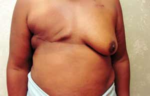 Breast Reconstruction