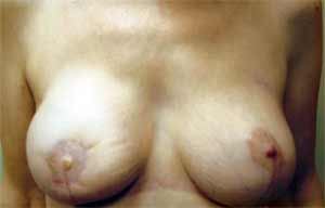 Breast Reconstruction