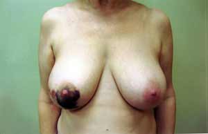 Breast Reconstruction