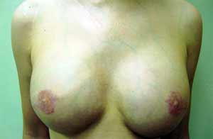 Breast Reconstruction