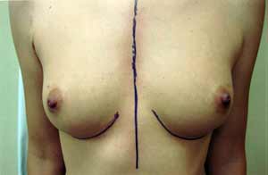 Breast Reconstruction