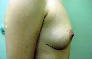 Breast Reconstruction