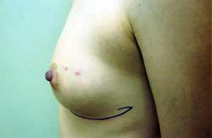 Breast Reconstruction