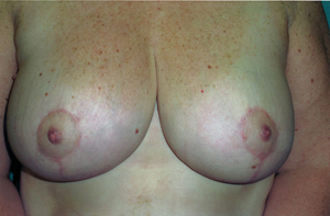 Breast reduction post treatment photo