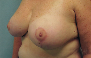Breast reduction post treatment photo