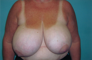 Breast reduction before photo