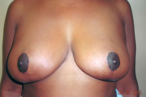Breast reduction post treatment photo